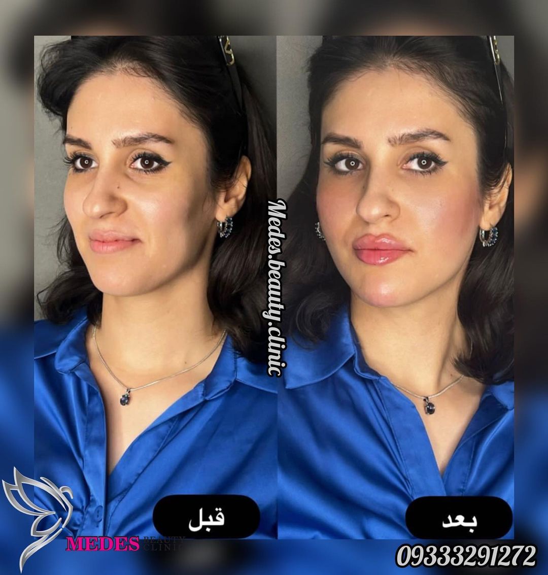 گالری زاویه سازی صورت